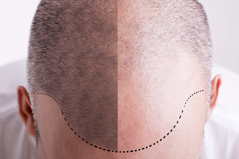 Finer Points of PRP Therapy for Hair Loss