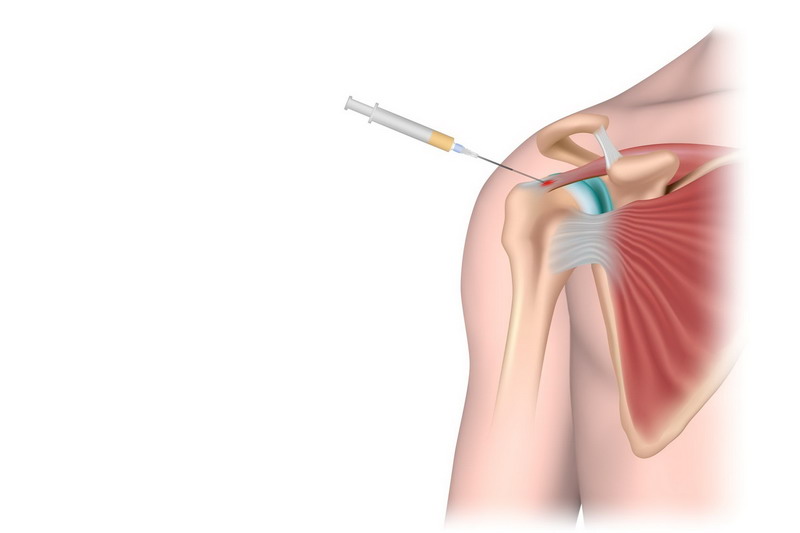 FDA Confirms the Safety of Rotator Cuff Stem Cell Procedure